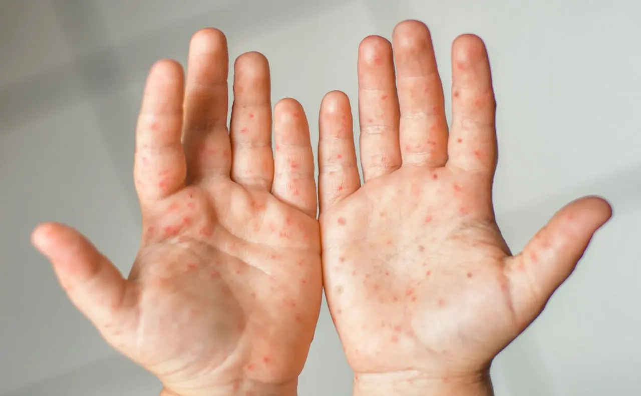 На Київщині зафіксували спалах вірусу Коксакі: захворіли 13 дітей